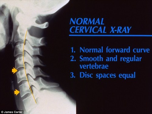X-Ray showing normal cervical curve.jpg
